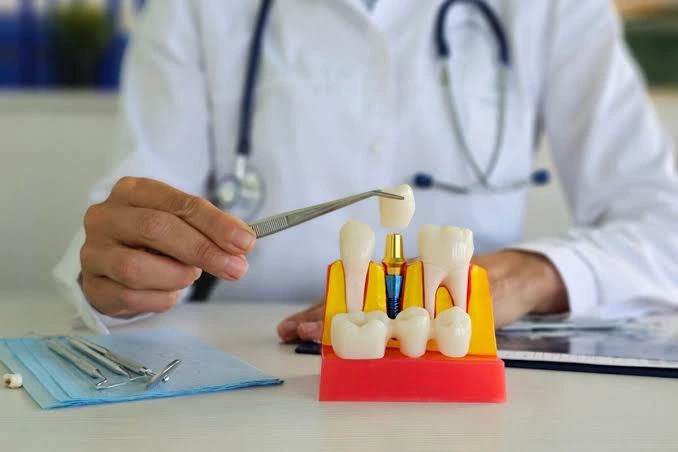 Understanding the Long-term Care Required After Dental Implants Long-term Care Required After Dental Implants