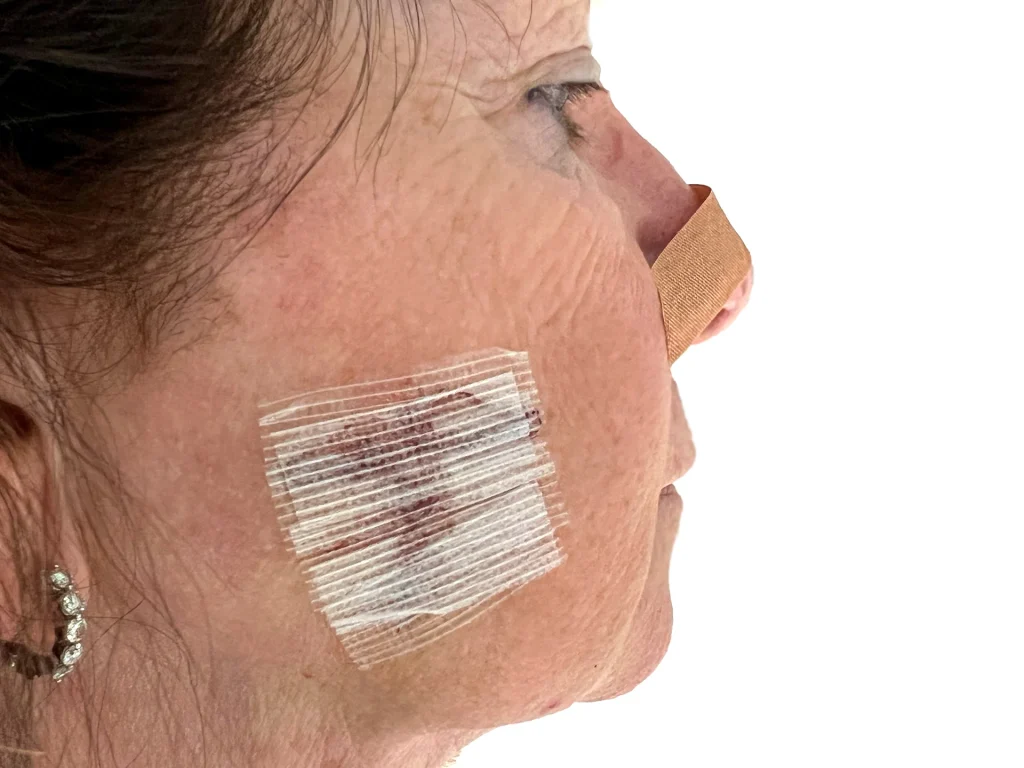 What To Expect During a Mohs Surgery Procedure Mohs Surgery