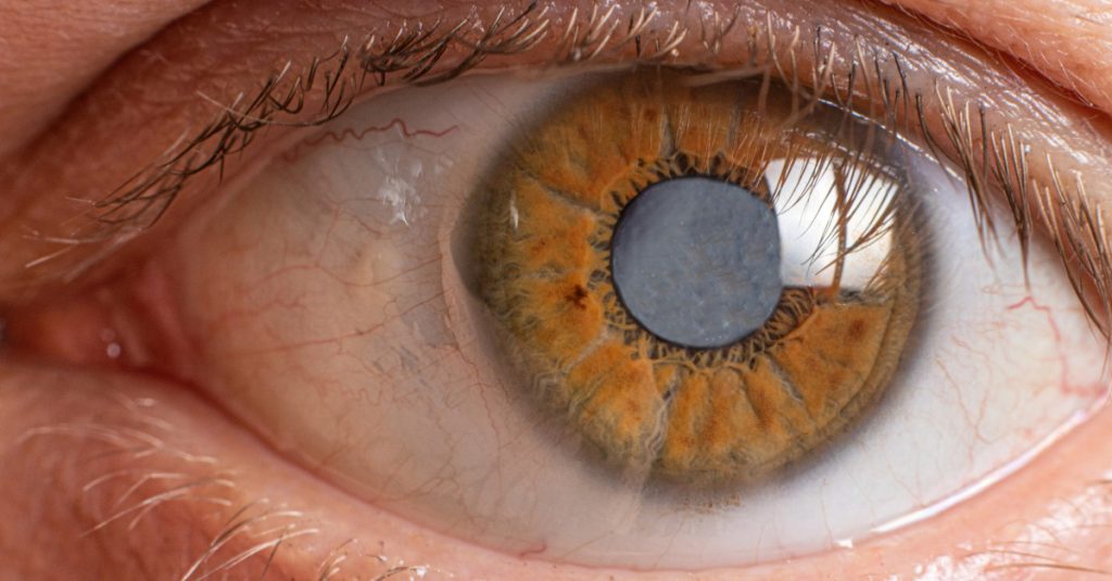 Symptoms, Diagnosis, and Treatment Options for Cataracts Treatment Options for Cataracts