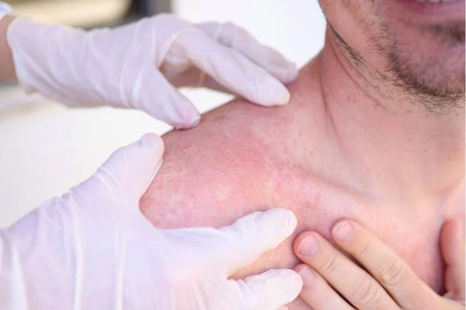 How Dermatologists Can Help with Seasonal Skin Issues Seasonal Skin Issues